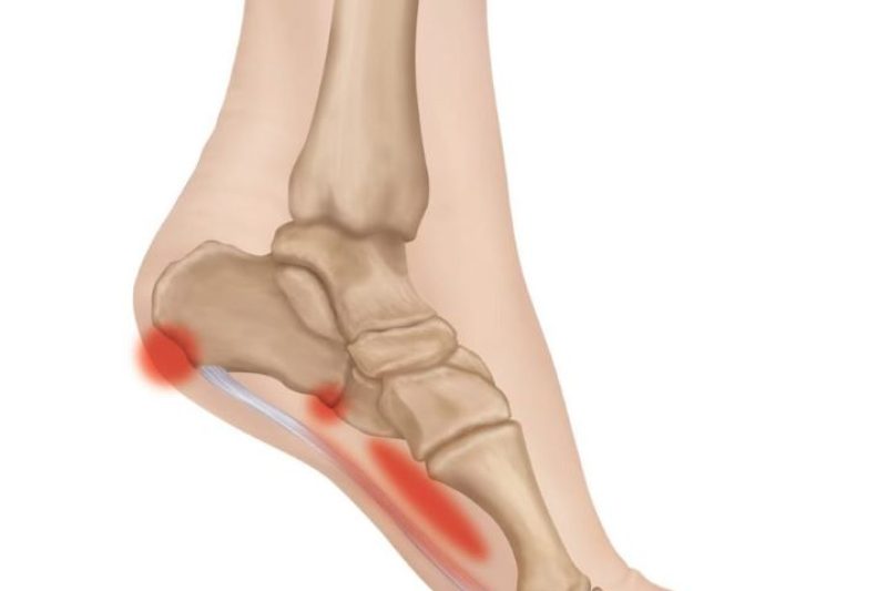 Understanding Plantar Fasciitis Causes, Symptoms, Treatment, and Prevention