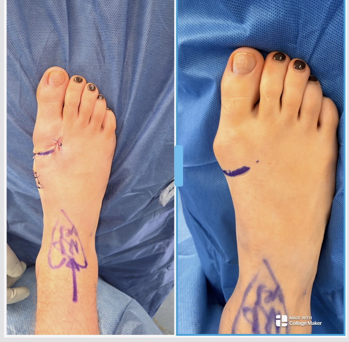 Metal-Free Bunion Surgery with OSSIO Technology