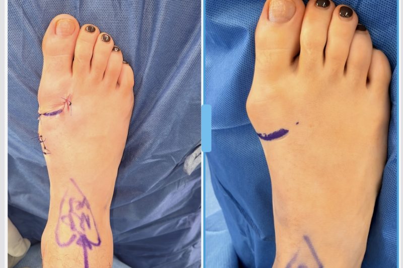Why Patients in Northeast Ohio Are Choosing Minimally Invasive Bunion Surgery